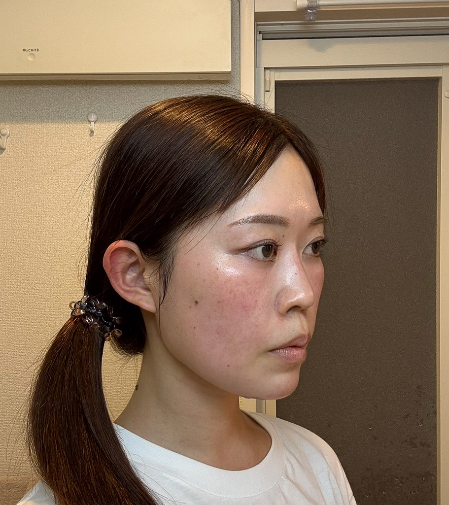 顔の脂肪吸引