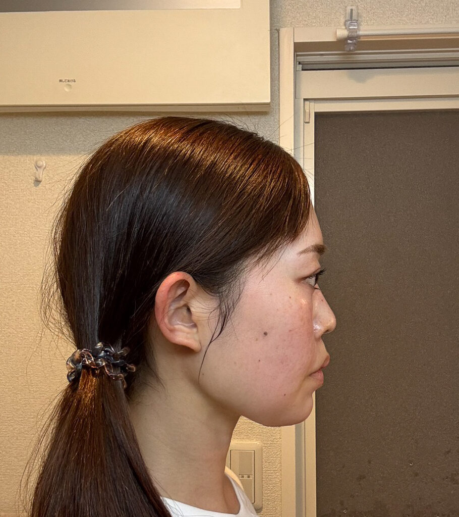 顔の脂肪吸引
