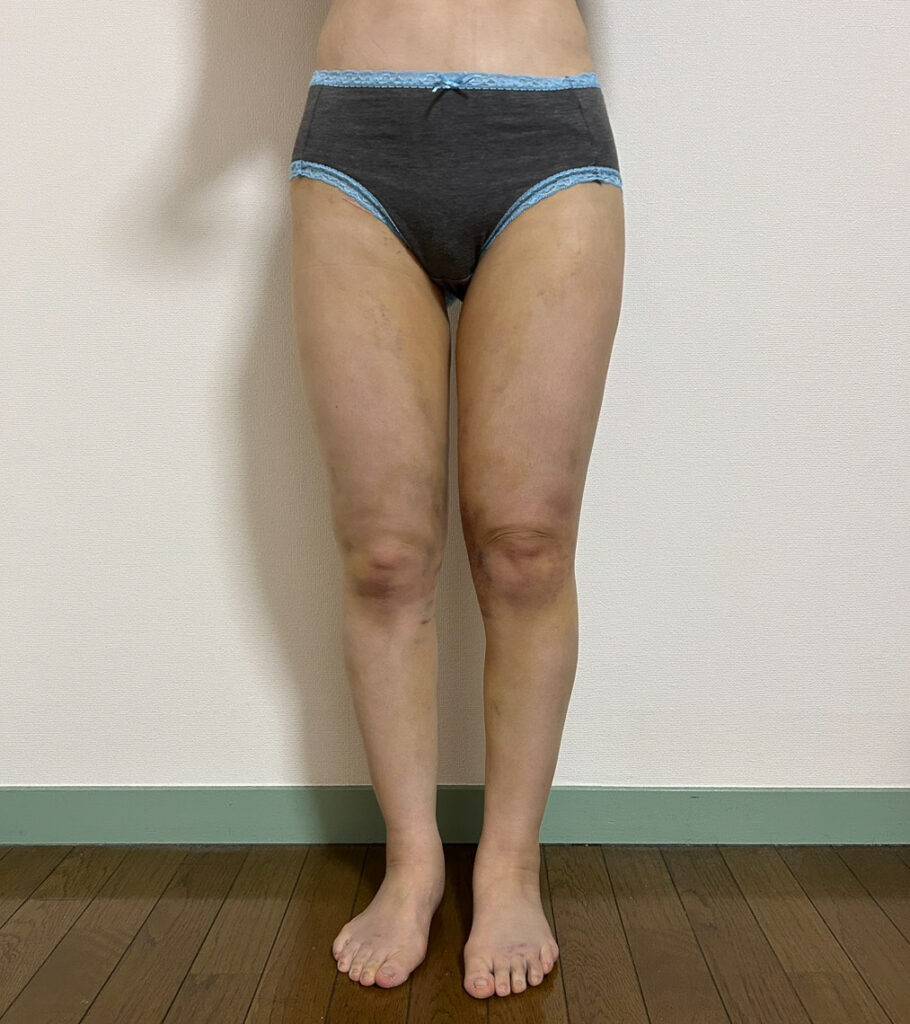 足の脂肪吸引