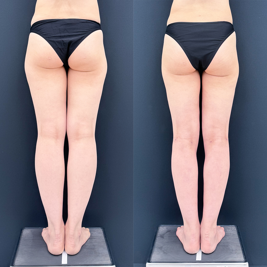 https://purelys-tokyo-clinic.com/wp/wp-content/uploads/2026/06/leg-Liposuction_Case-No.1022.jpg