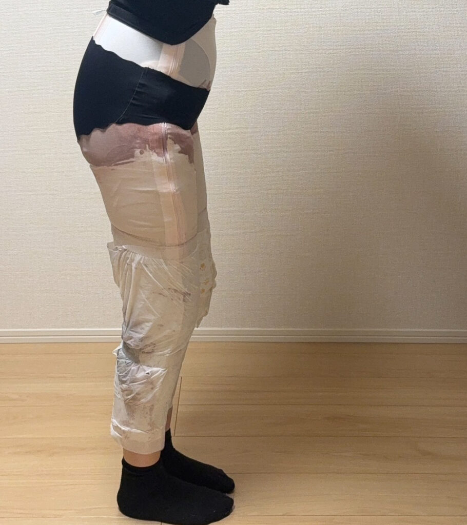 足の脂肪吸引