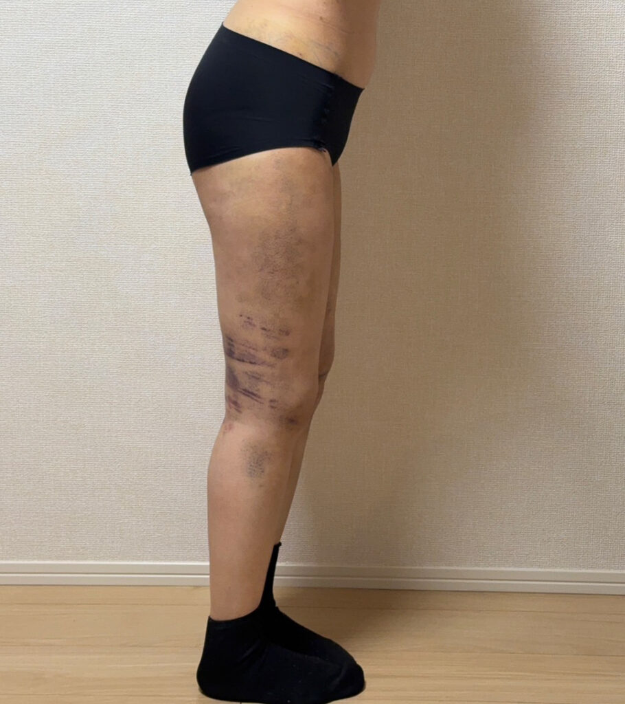 足の脂肪吸引
