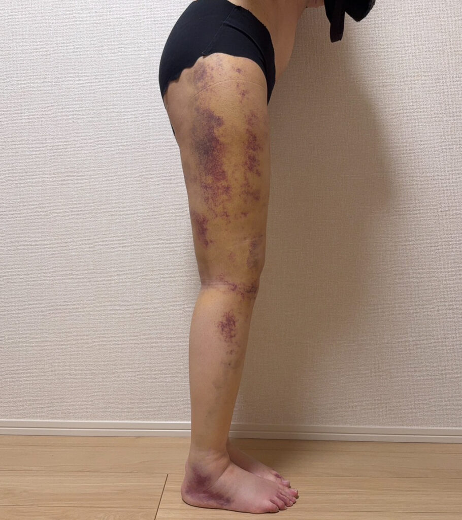 足の脂肪吸引
