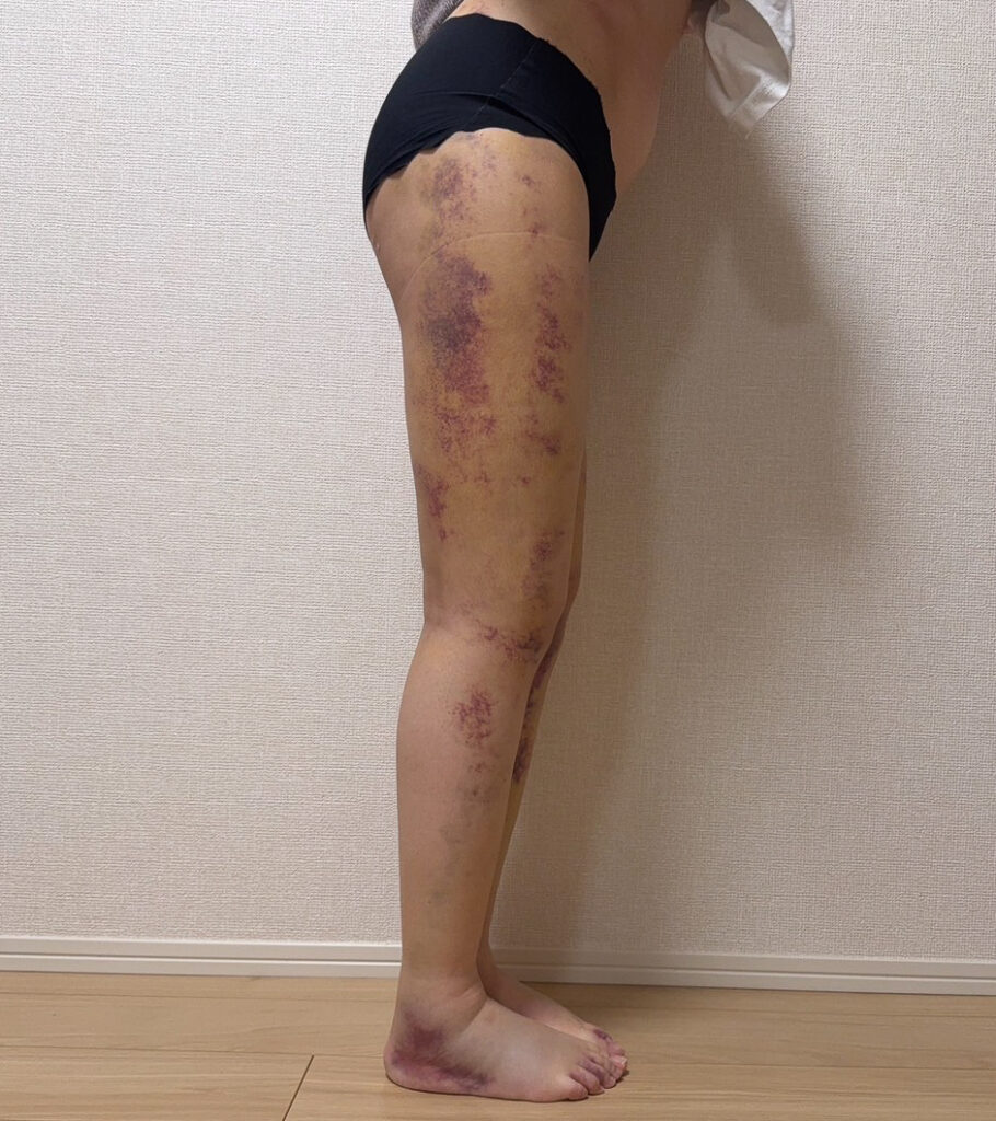 足の脂肪吸引
