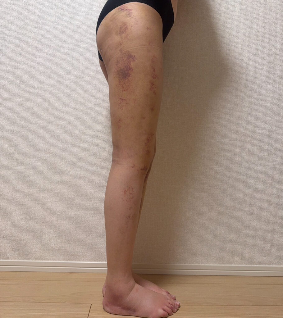 足の脂肪吸引