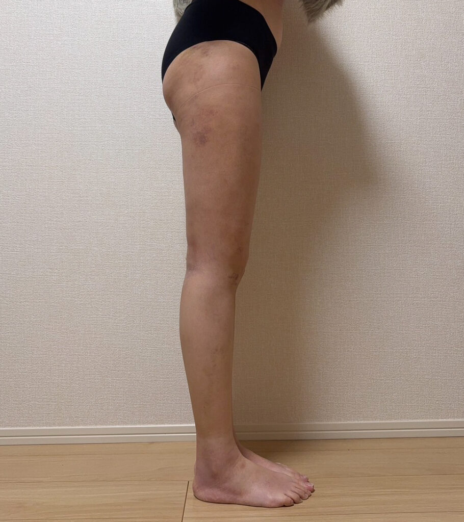 足の脂肪吸引