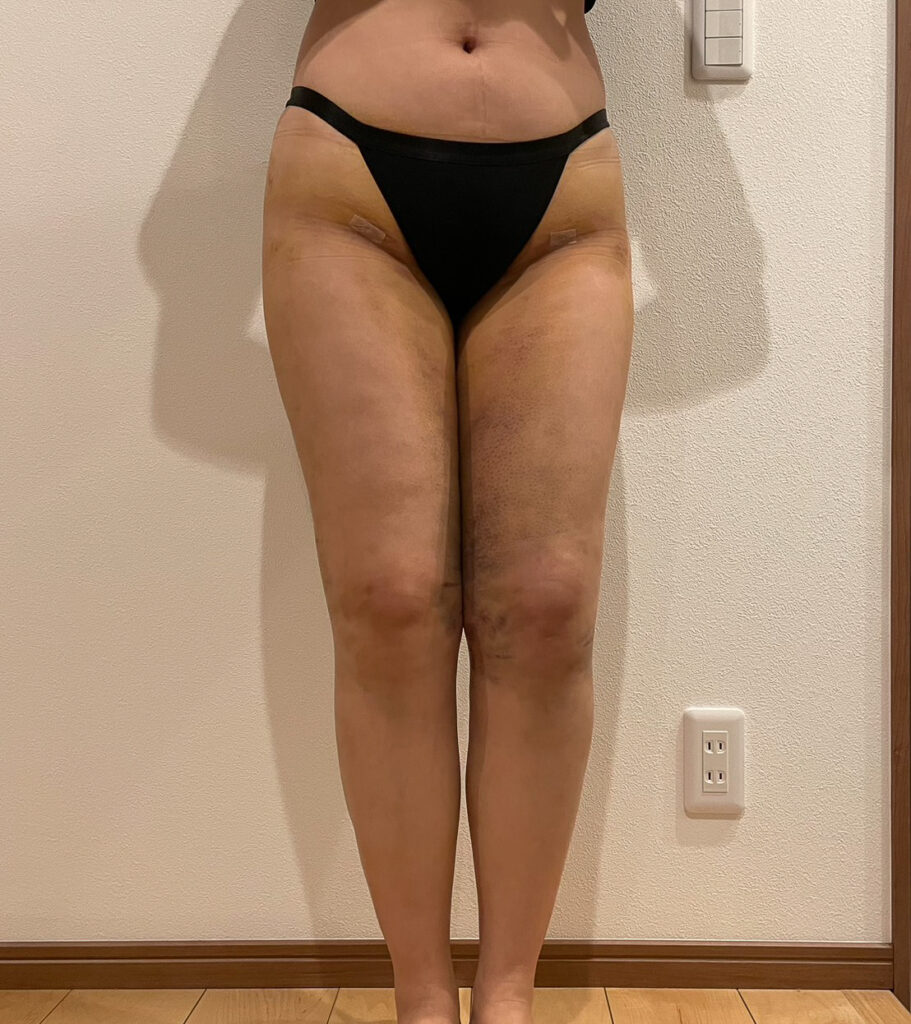 足の脂肪吸引