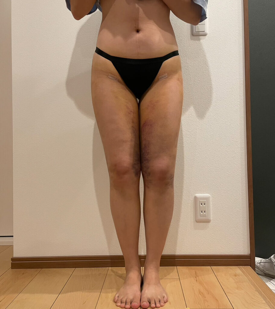 足の脂肪吸引