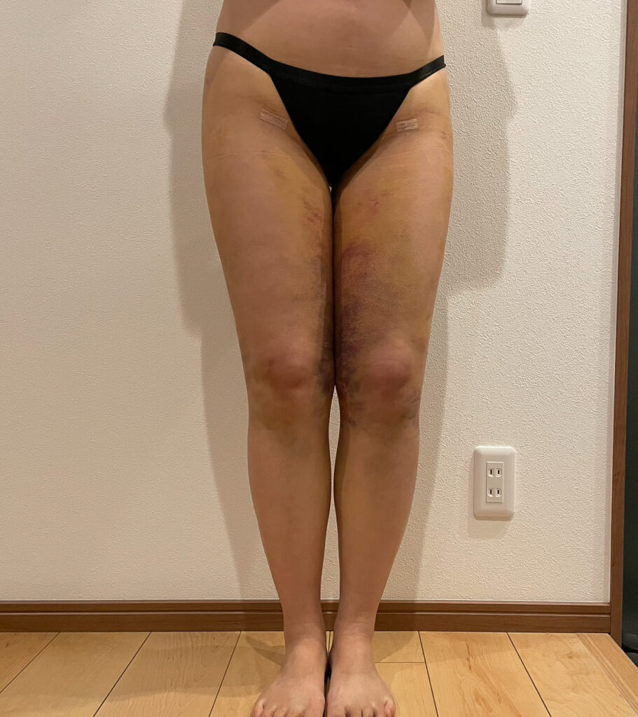 足の脂肪吸引