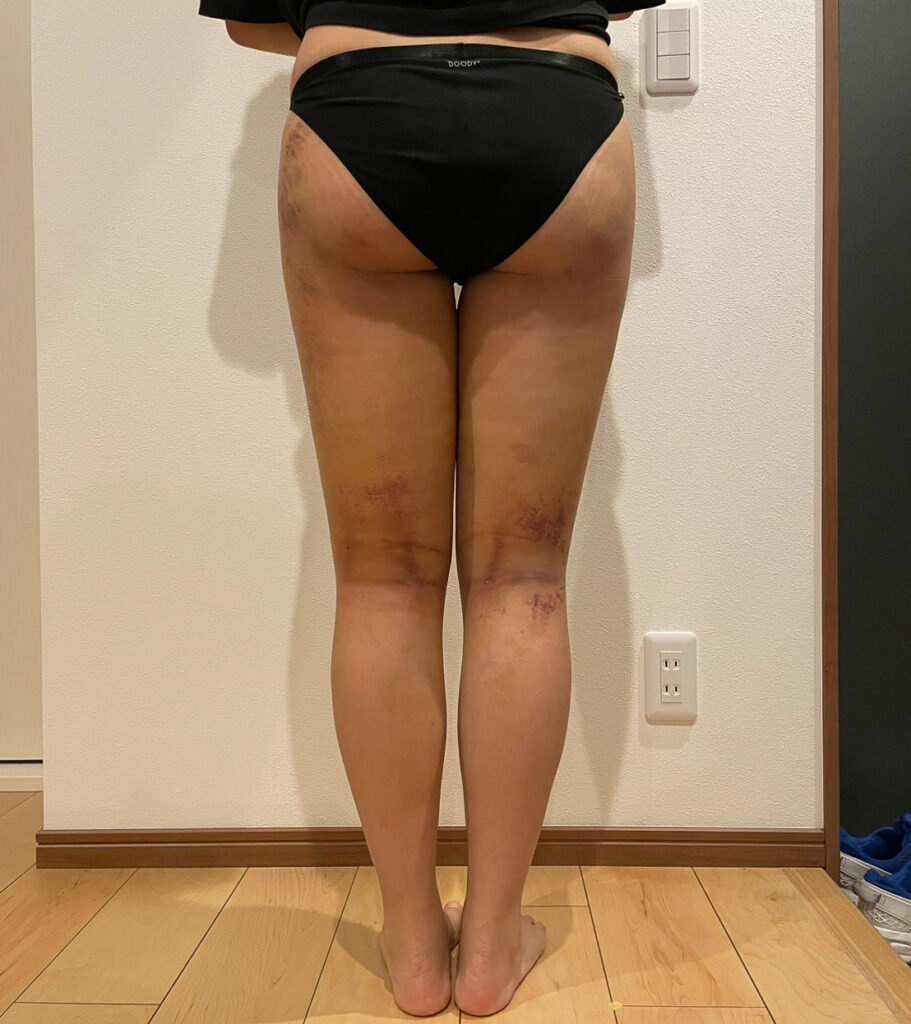 足の脂肪吸引