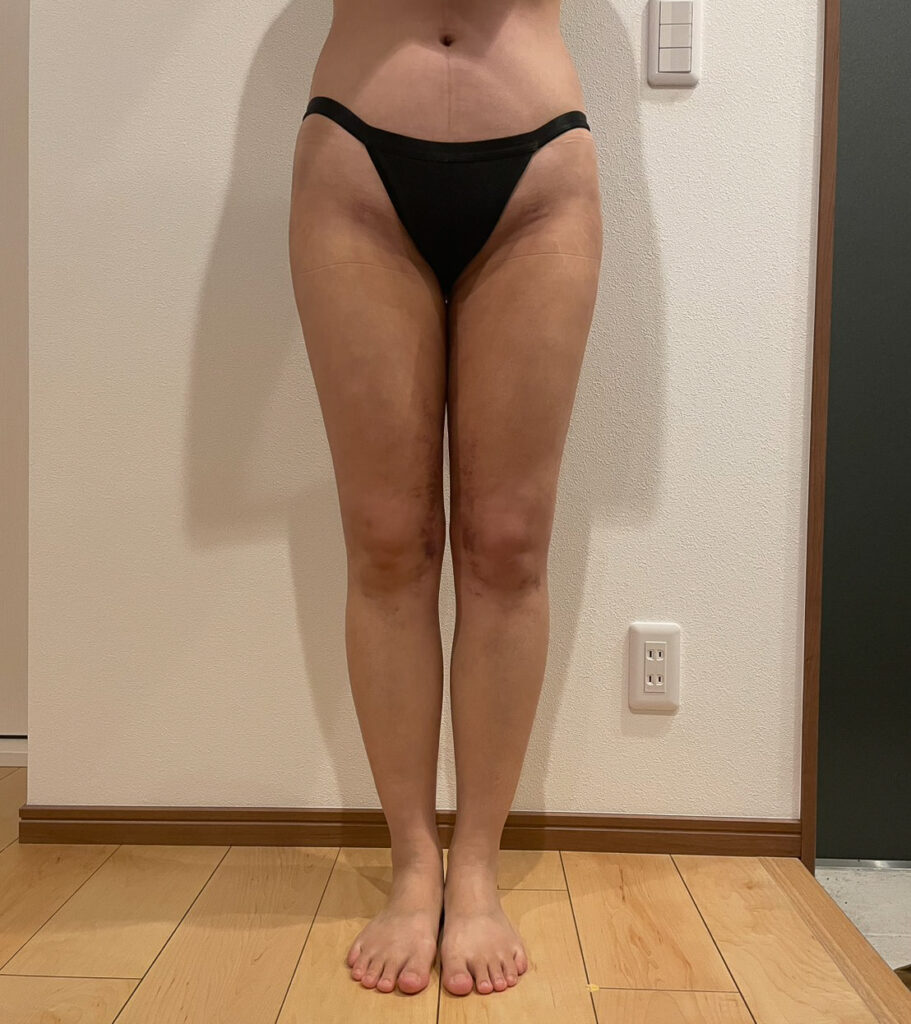 足の脂肪吸引