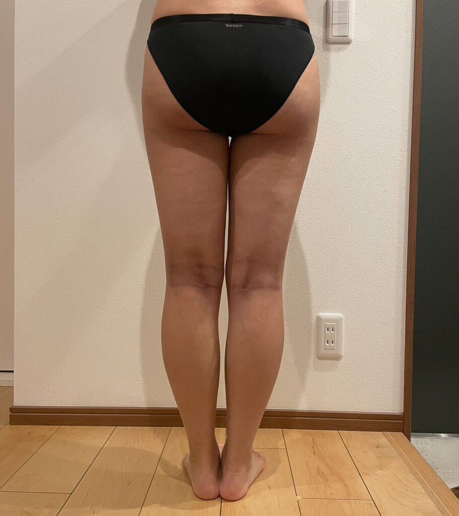 足の脂肪吸引
