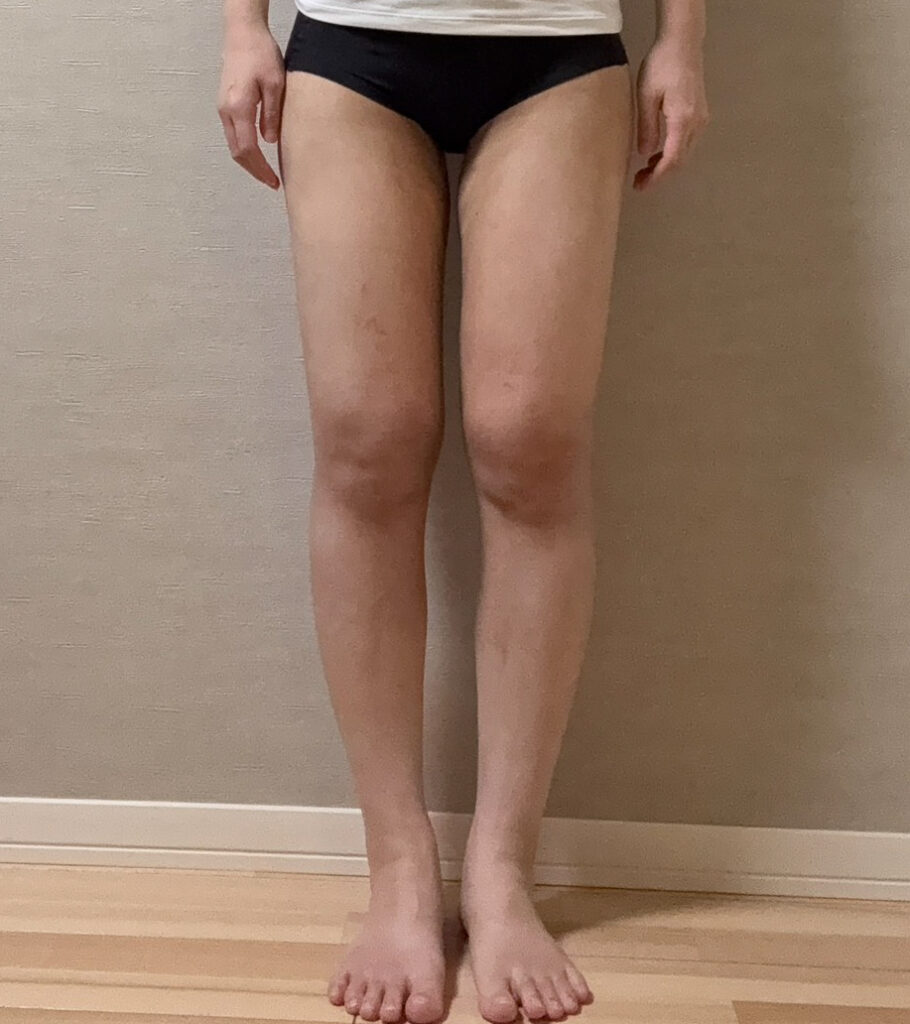 足の脂肪吸引