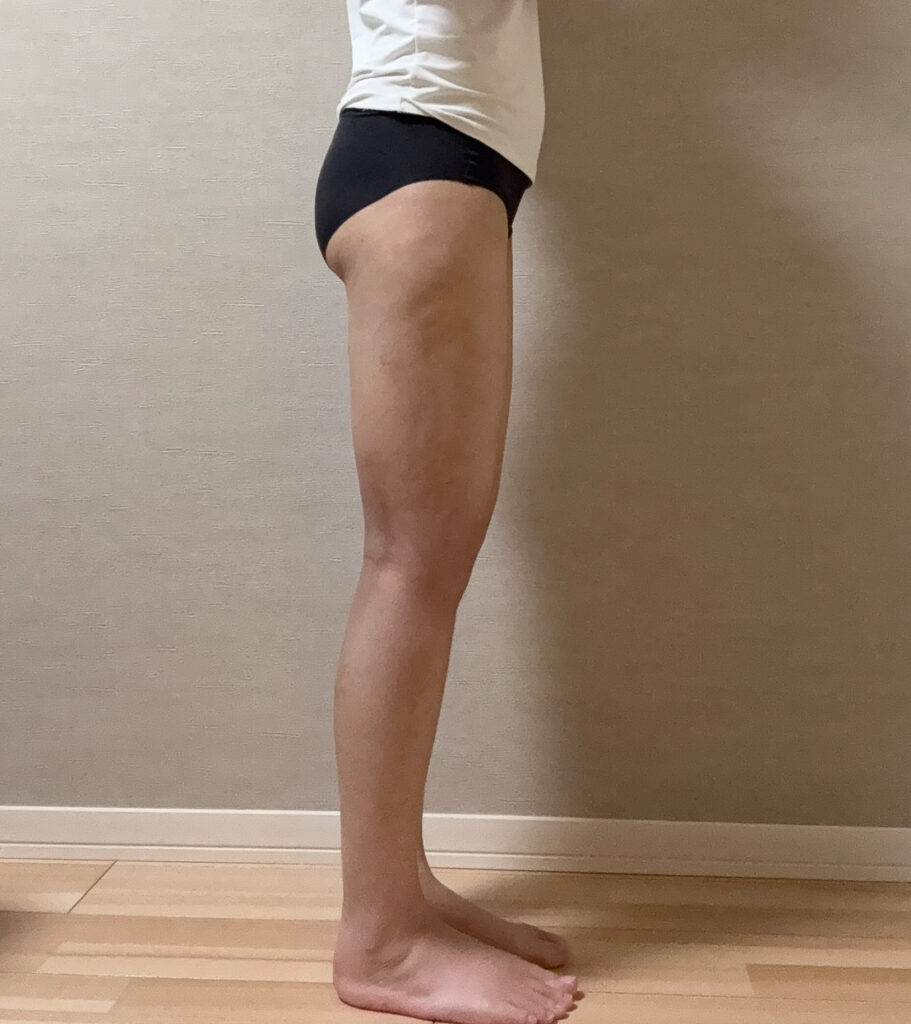 足の脂肪吸引
