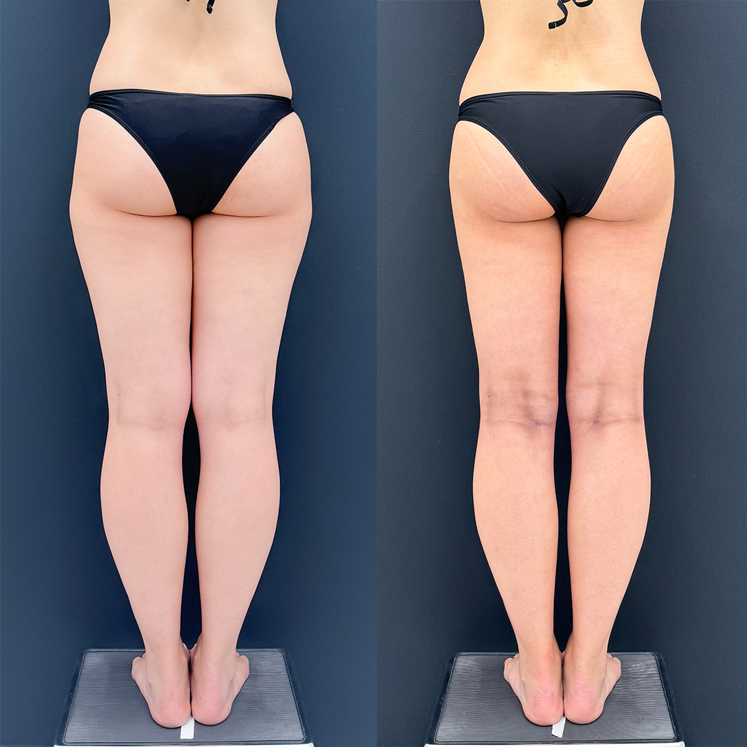 https://purelys-tokyo-clinic.com/wp/wp-content/uploads/2026/06/leg-Liposuction_Case-No.1093.jpg