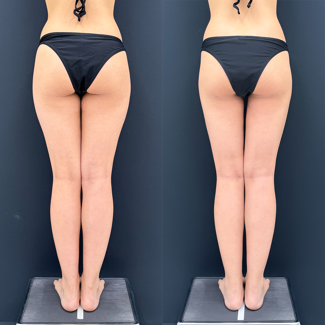 https://purelys-tokyo-clinic.com/wp/wp-content/uploads/2026/06/leg-Liposuction_Case-No.989.jpg
