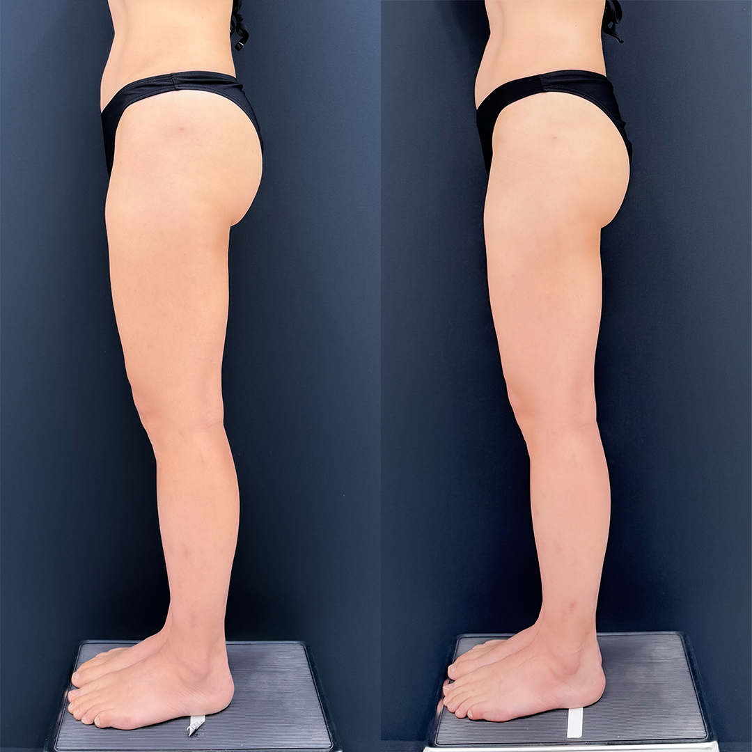 https://purelys-tokyo-clinic.com/wp/wp-content/uploads/2026/06/leg-Liposuction_Case-No.992.jpg