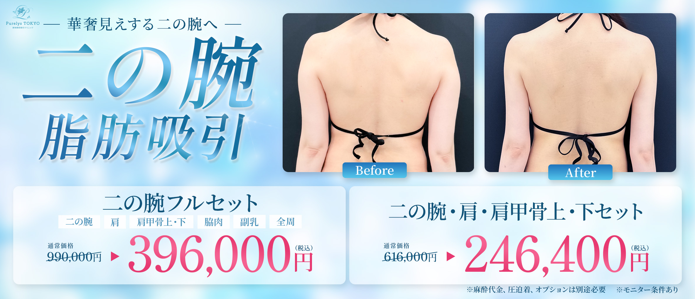 二の腕の脂肪吸引