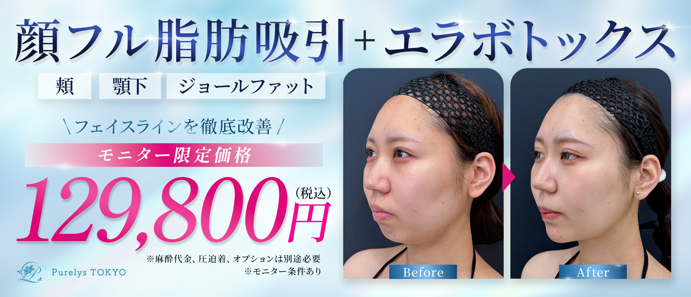 顔の脂肪吸引