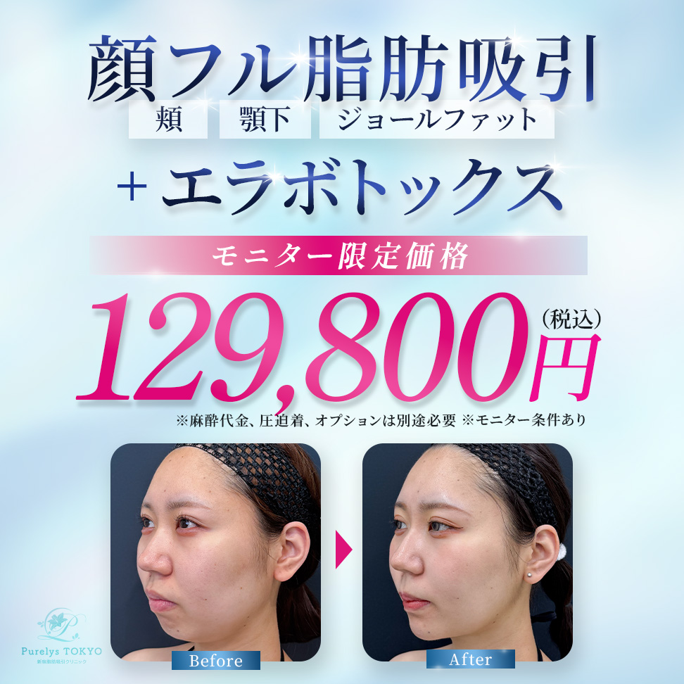 顔の脂肪吸引