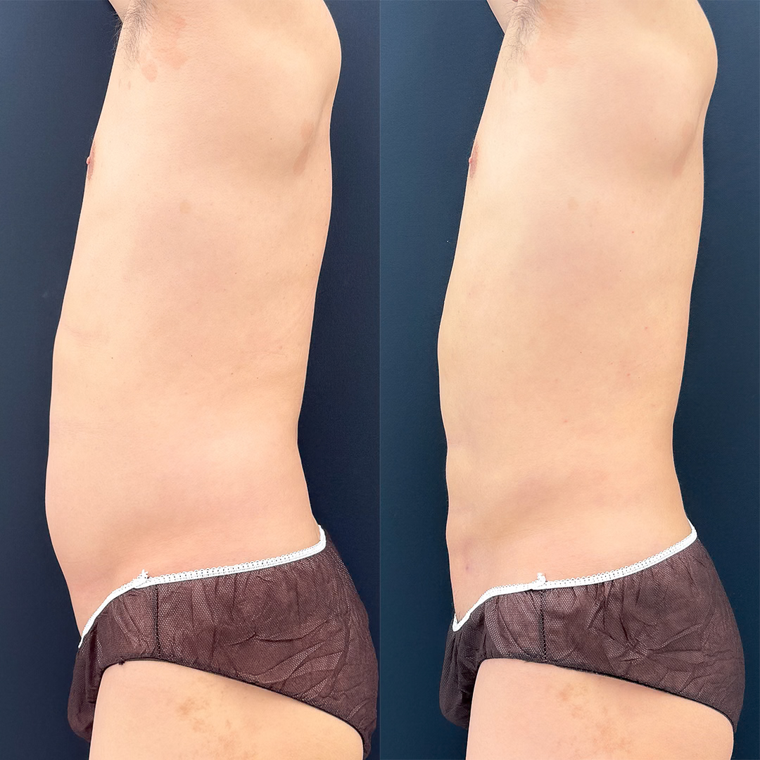 https://purelys-tokyo-clinic.com/wp/wp-content/uploads/2026/07/Before-and-After-abdominal-Liposuction_Case-No.276.jpg
