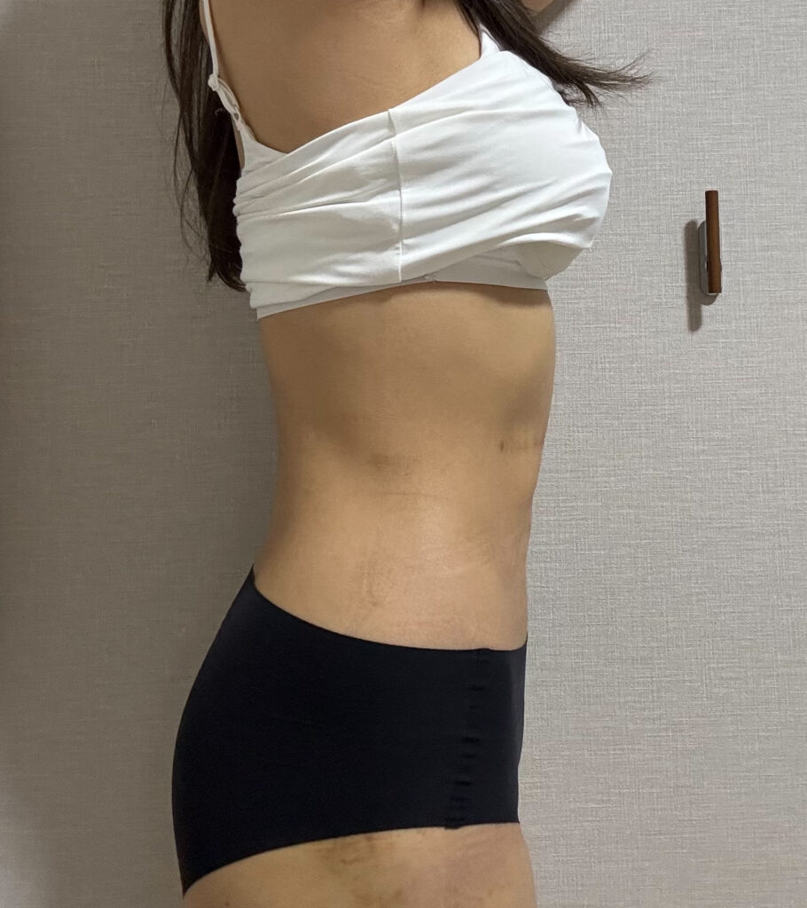 コンデンスリッチ脂肪豊胸