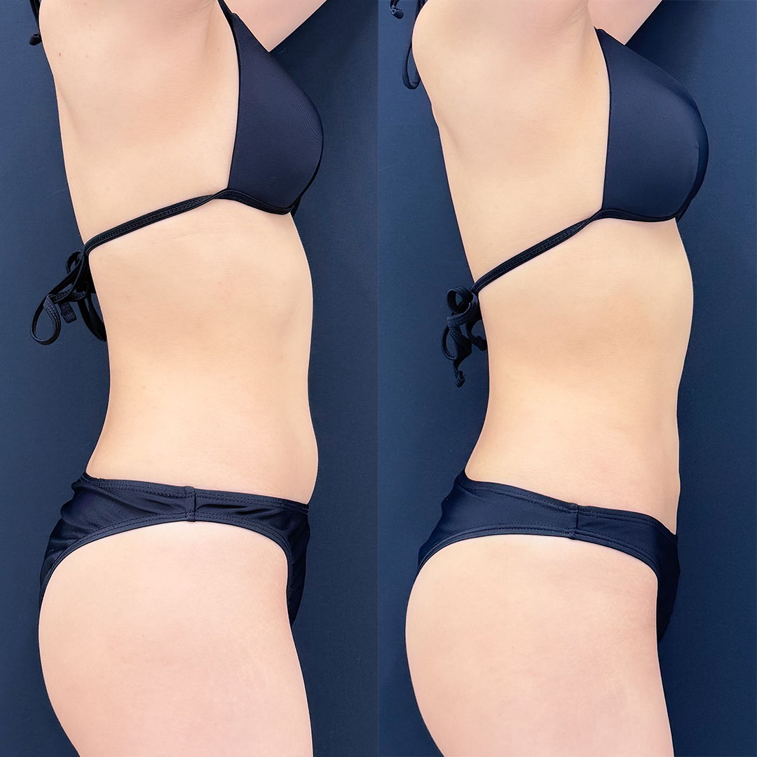 https://purelys-tokyo-clinic.com/wp/wp-content/uploads/2026/07/breast-augmentation_Case-No.394.jpg