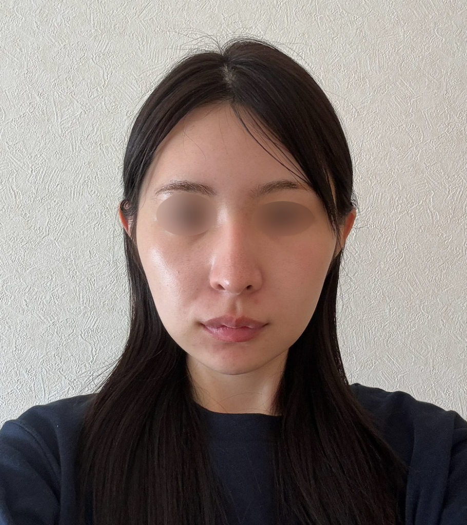 ■術後30日目の症例写真