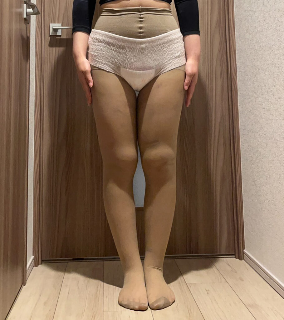 足の脂肪吸引