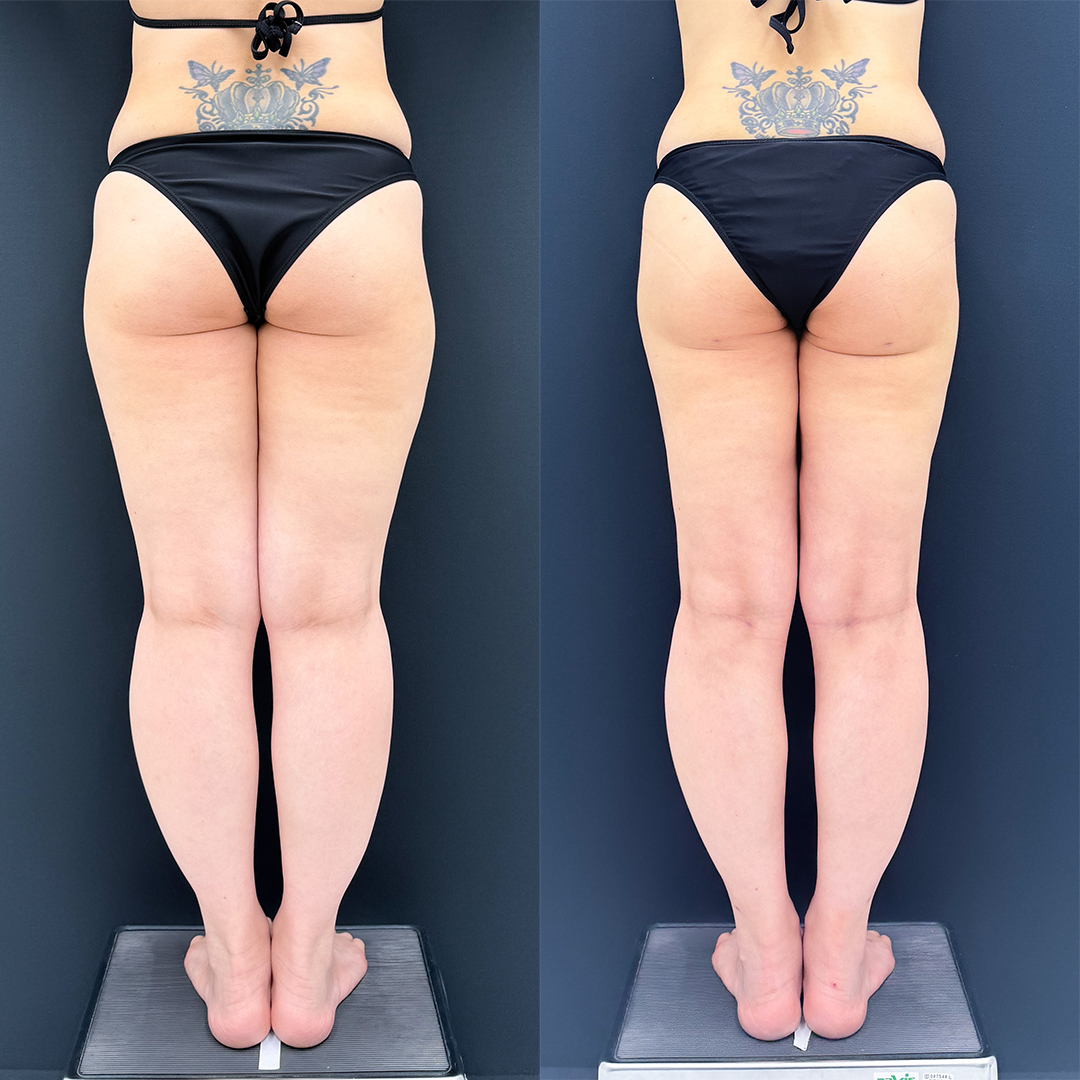 https://purelys-tokyo-clinic.com/wp/wp-content/uploads/2026/07/leg-Liposuction_Case-No.2069.jpg