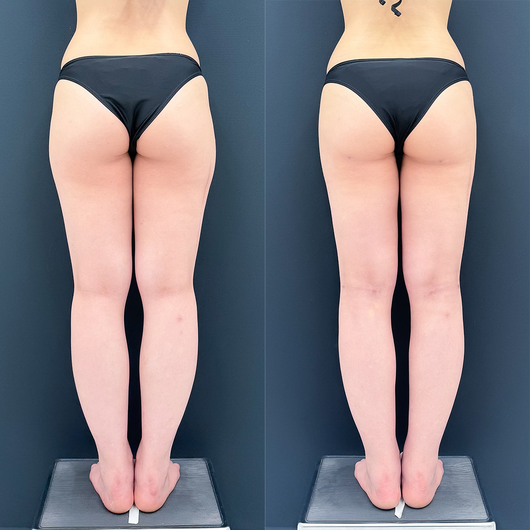 https://purelys-tokyo-clinic.com/wp/wp-content/uploads/2026/07/leg-Liposuction_Case-No.2073.jpg