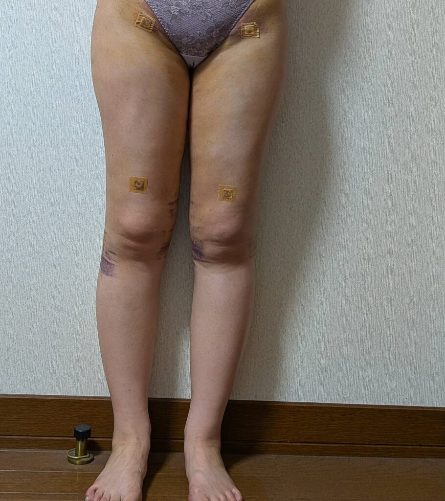 足の脂肪吸引