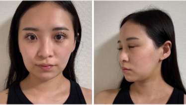 ■術後5日目の症例写真