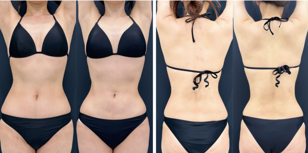 術後6ヶ月ほどでむくみと拘縮はほぼ落ち着き、最終的なシルエットが見えてきます。