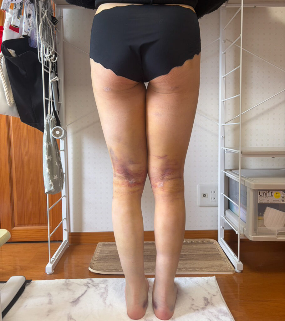 足の脂肪吸引