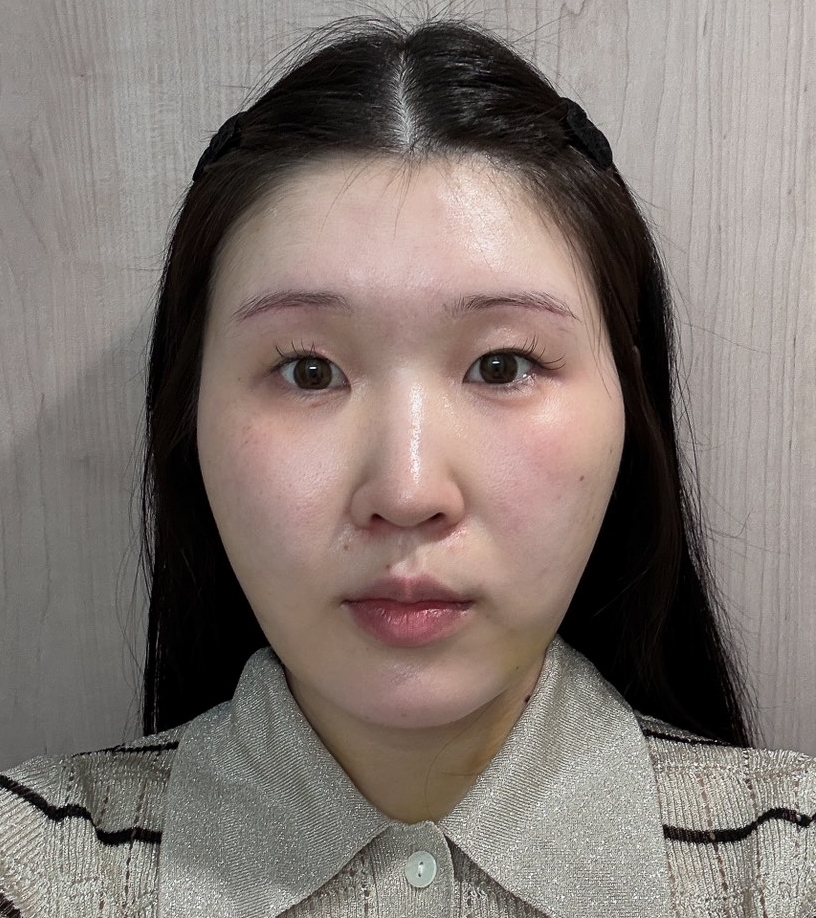 顔の脂肪吸引