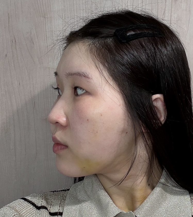 顔の脂肪吸引