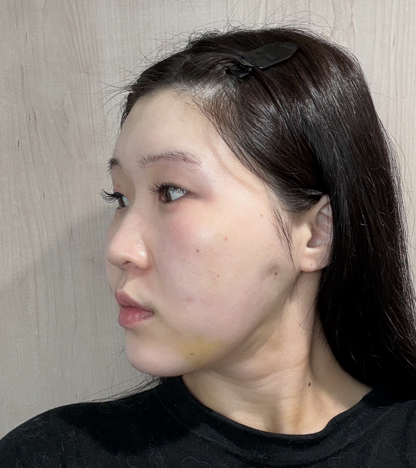 顔の脂肪吸引