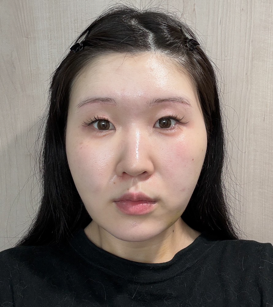 顔の脂肪吸引