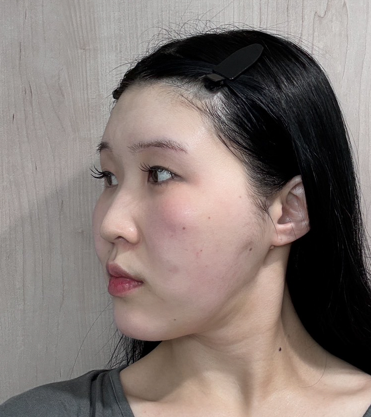 顔の脂肪吸引