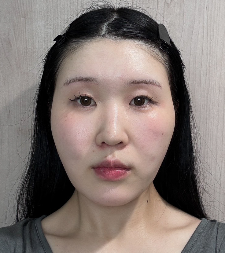 顔の脂肪吸引