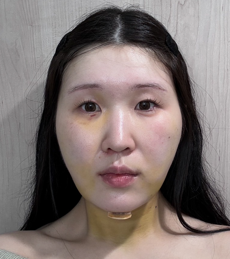 顔の脂肪吸引