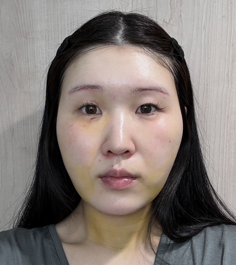 顔の脂肪吸引