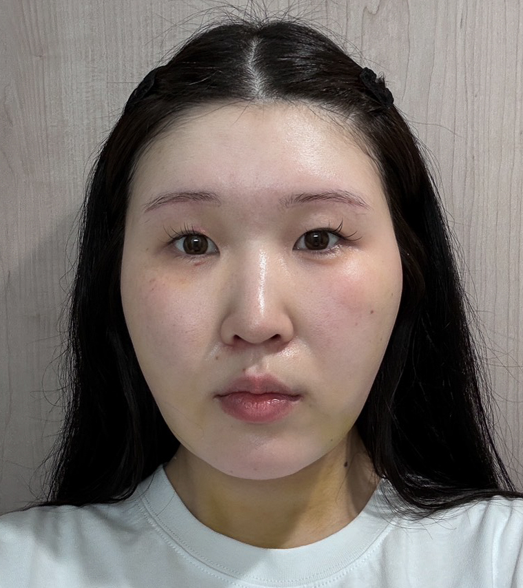 顔の脂肪吸引
