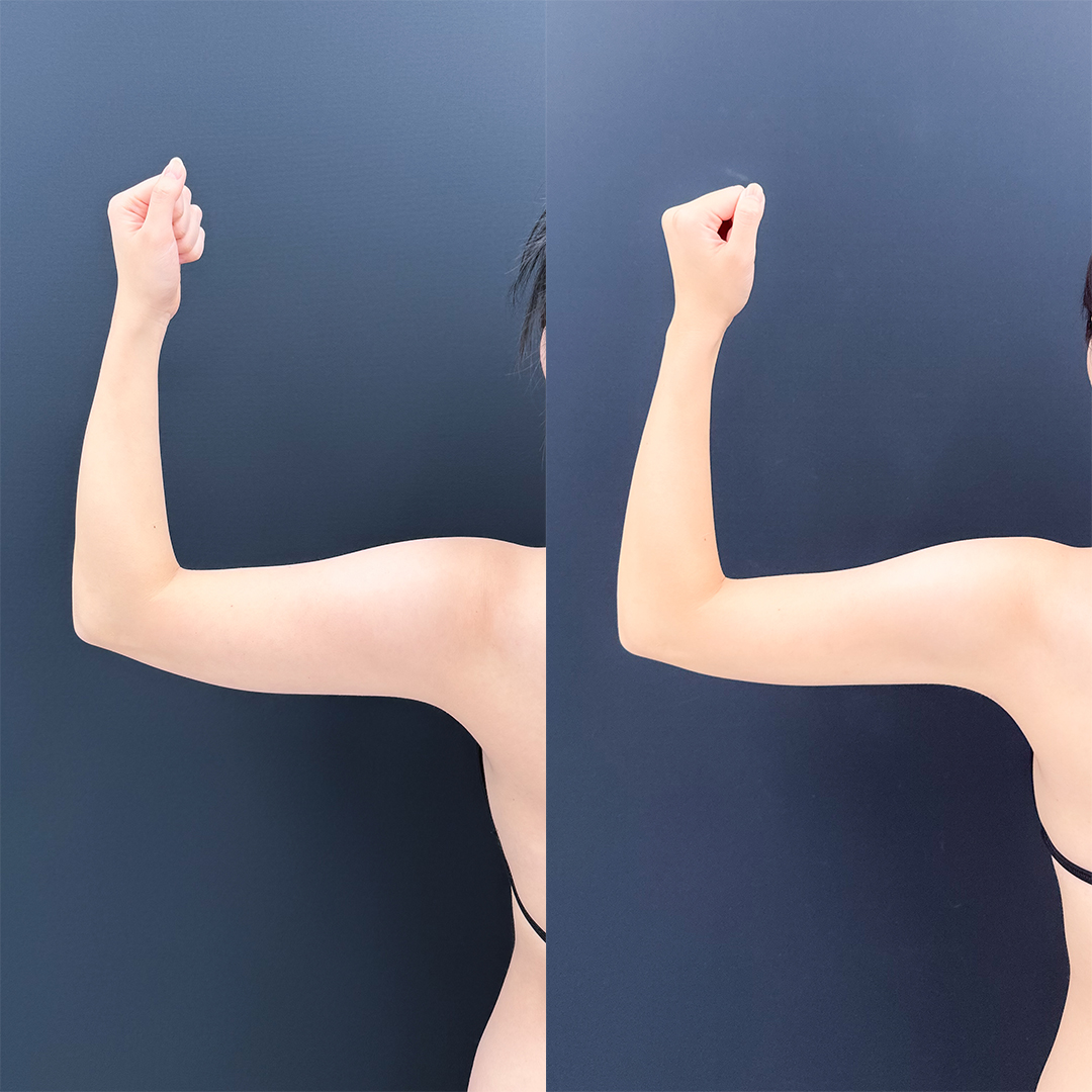 https://purelys-tokyo-clinic.com/wp/wp-content/uploads/2026/08/arm-Liposuction_Case-No.731.jpg