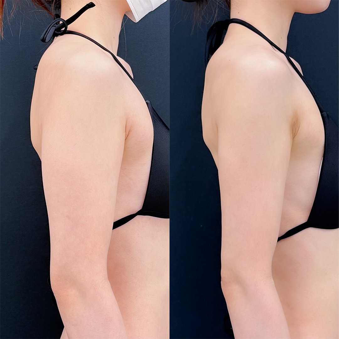 https://purelys-tokyo-clinic.com/wp/wp-content/uploads/2026/08/arm-Liposuction_Case-No.733.jpg