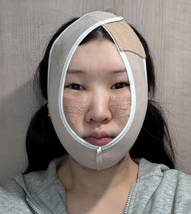 顔の脂肪吸引