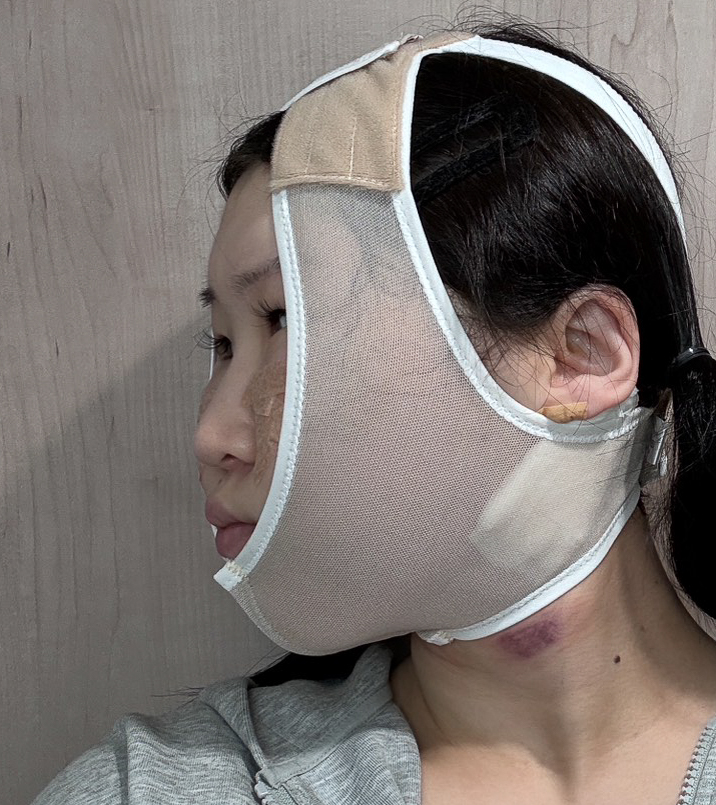 顔の脂肪吸引