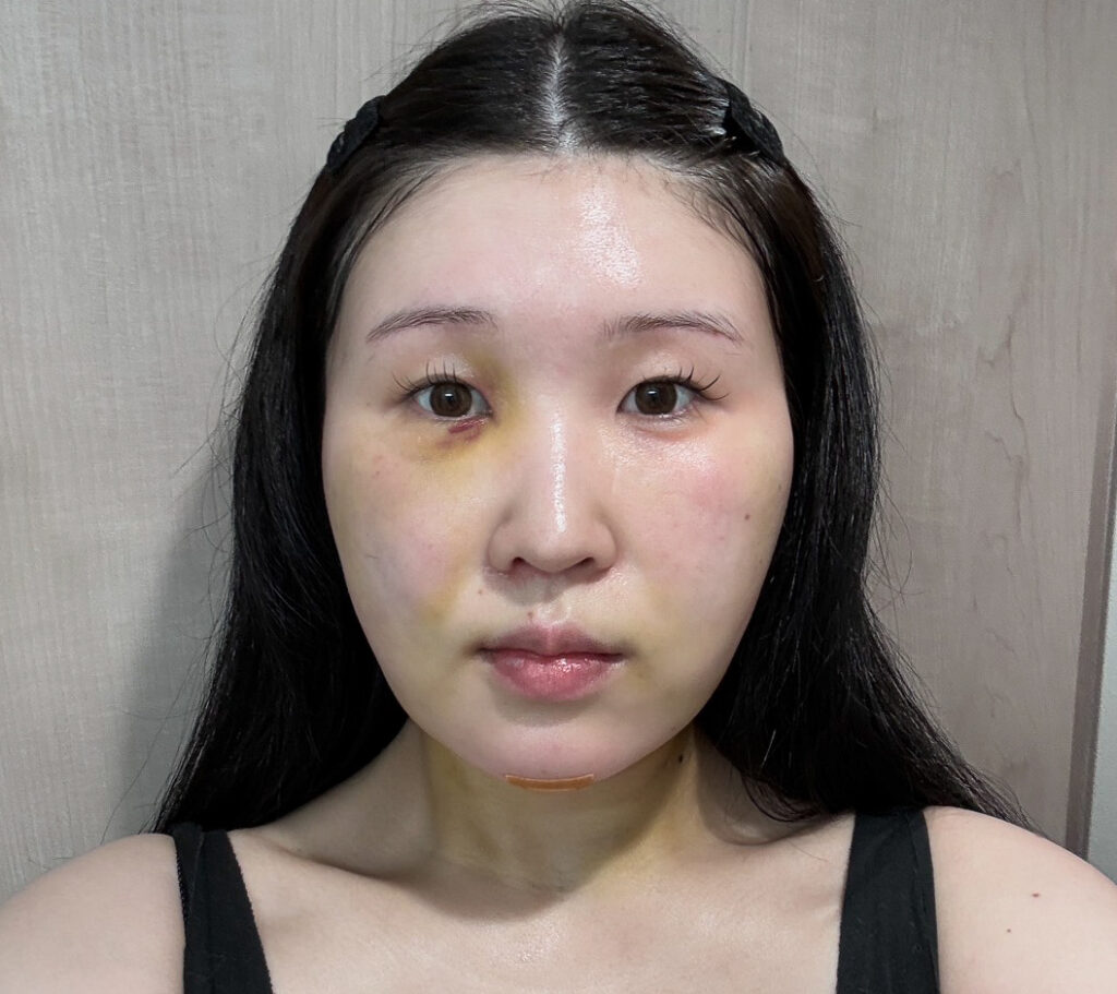 顔の脂肪吸引