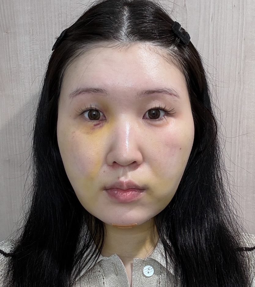 顔の脂肪吸引